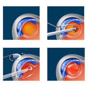 cataract-surgery-diagram | Glaucoma-Cataract Consultants